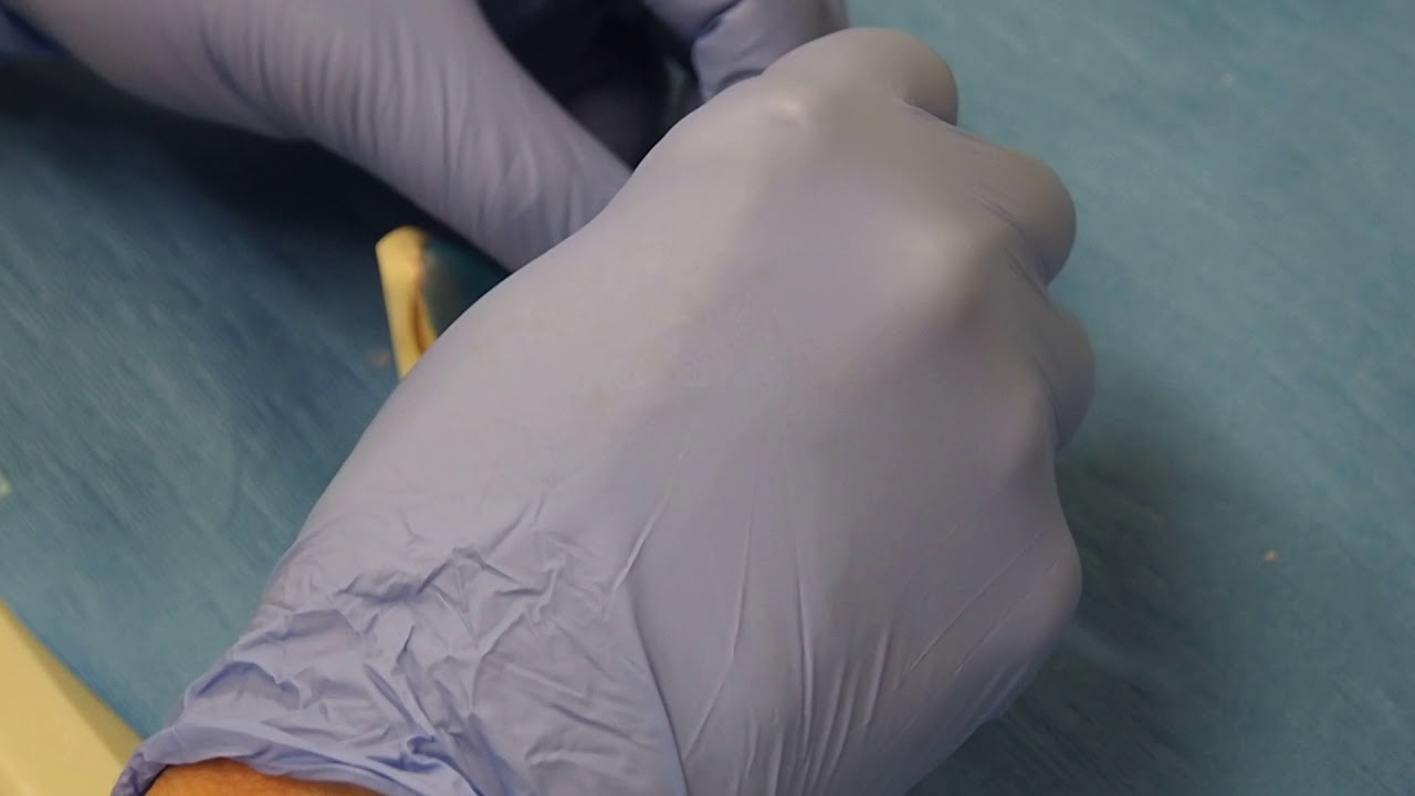 Impression trays 6 VanNorwick's lower tray