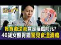 胃食道逆流延遲就醫恐罹食道癌！40歲女治療半年沒好照胃鏡驚見「食道1cm潰瘍」【東森醫起看】