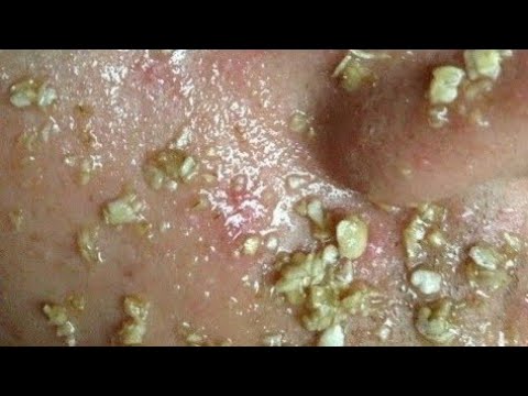 Video Compilation of Blackhead Extraction - youtube