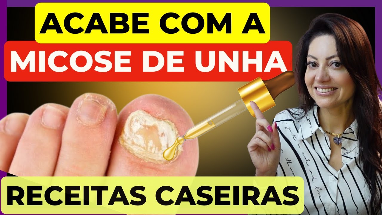 Descubra o SEGREDO para ACABAR com a MICOSE de UNHA! | Dra. Greice ...