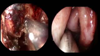 Cocaine Destroys Your Nose