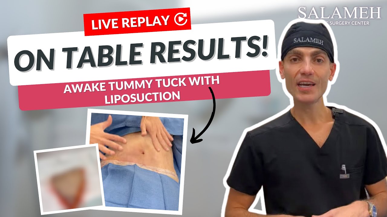 Live On-Table Results for Awake Tummy Tuck with Liposuction | Salameh Plastic Surgery