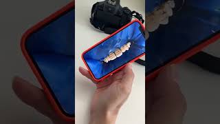 Lamine Veneer Yani Yaprak Porselenler Nedir?