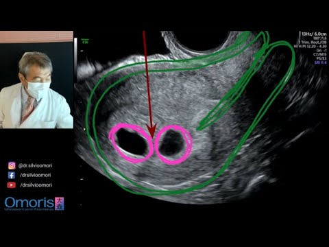 Video: Kāda ir iespēja iestāties grūtniecība ar divragu dzemdi?