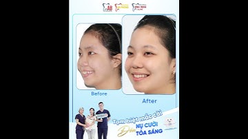 TẠM BIỆT MẮC CÀI – ĐÓN NỤ CƯỜI TỎA SÁNG #hethongnhakhoaab #nhakhoahue #shorts