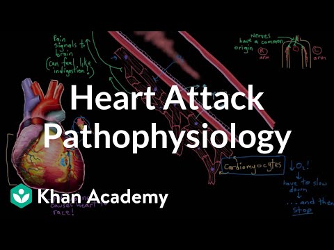 Heart attack (myocardial infarction) pathophysiology | NCLEX-RN | Khan Academy