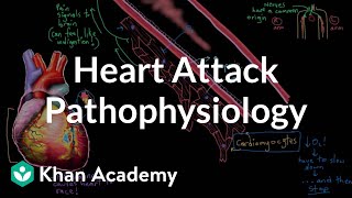 Heart attack (myocardial infarction) pathophysiology | NCLEX-RN | Khan Academy