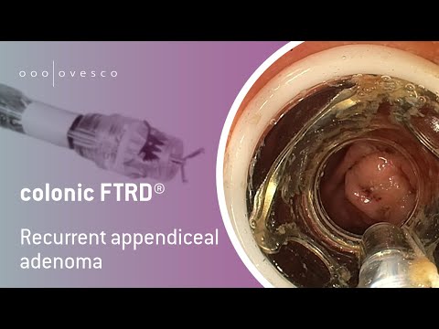 FTRD® System | colonic FTRD | Resection of a recurrent appendiceal adenoma