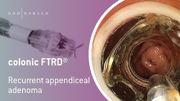 FTRD® System | colonic FTRD | Resection of a recurrent appendiceal adenoma