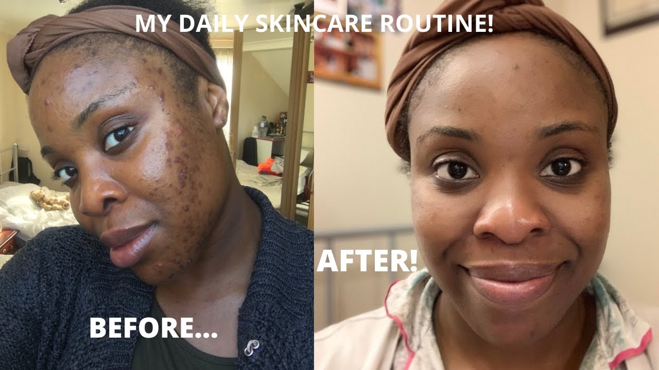 MY DAILY SKINCARE ROUTINE | HOW TO GET RID OF DARK SPOTS IN TWO MONTHS ...
