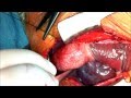 Congenital Heart Surgery , performed by Prof. Dr. Adel Al Gamal , Mansoura Hospitals.