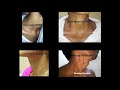Comparison of Neck venous patterns. Examining a cardiac patient #mbbs #medicine #neetpg #neet #next