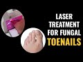 Laser Treatment For Fungal Toenails