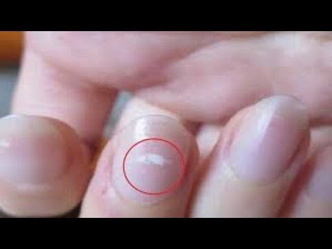 Video: 3 cách để loại bỏ đốm trắng trên móng tay của bạn