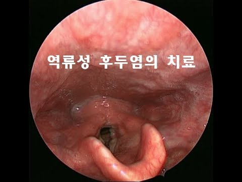 인후두역류질환 - 역류성 후두염 / 목 이물감 / 목소리 변화