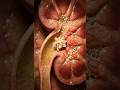 How Kidney Stones Block Urine Flow: An Inside Look