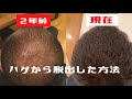 【薄毛】【ハゲ】は3つの事をすればフサフサに【AGA治療】