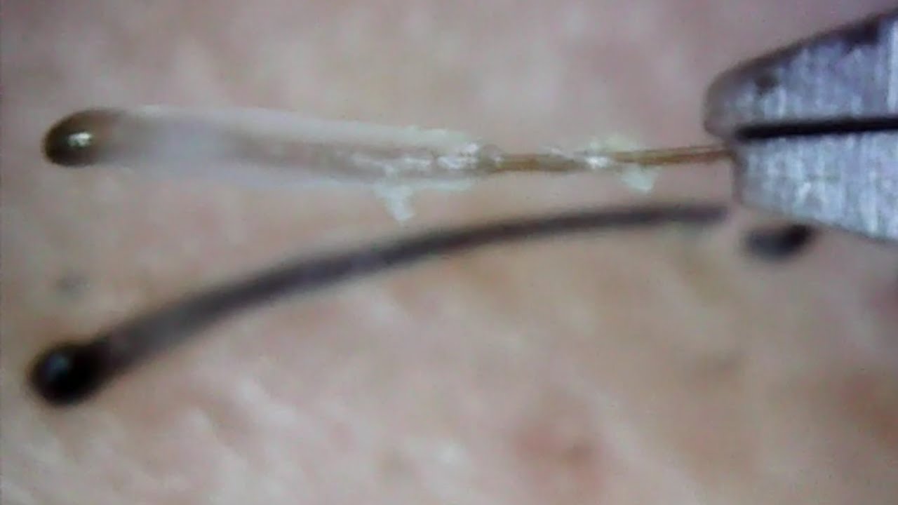 すべてのカタログ 最高 髭 抜く 癖