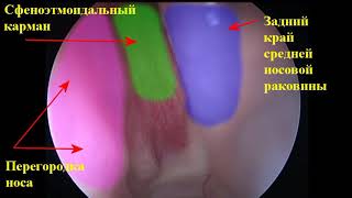 18 Анатомия полости носа при эндоскопическом осмотре