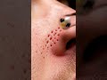 Side-Nose Curve Precision Vacuuming #macroasmr #satisfying #blackheadcaique #skincare #satisfyling