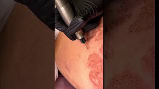 Удаление растяжек методом fibroblast