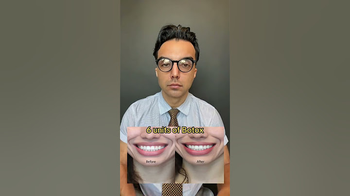 Botox for gummy smiles
