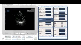 LV Mass.Truncated Ellipsoid Method