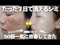 🇯🇵【シミ取り経過】たった7日後の美肌が過去一だった、繰り返すシミ治療を日本クリニックで終止符を‼︎