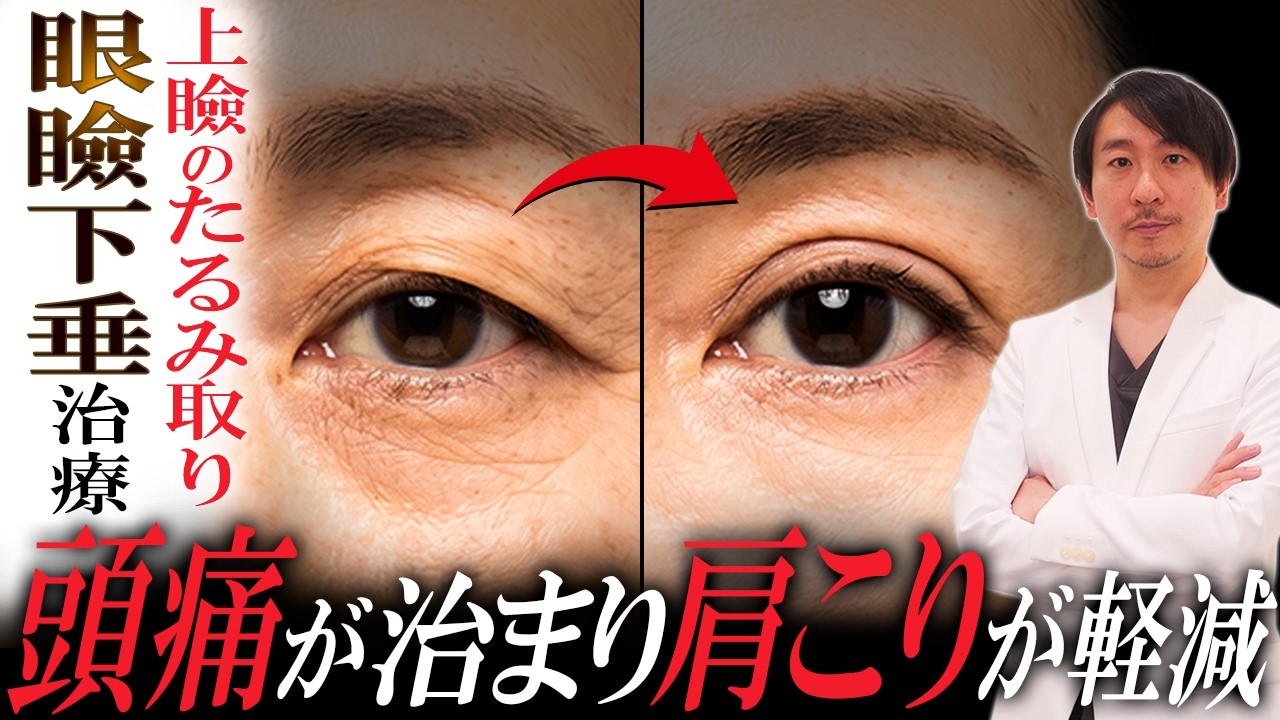 二重がなくなる!?眼瞼下垂で上瞼が重い方に向けてたるみ取り【頭痛・肩こり】 - YouTube