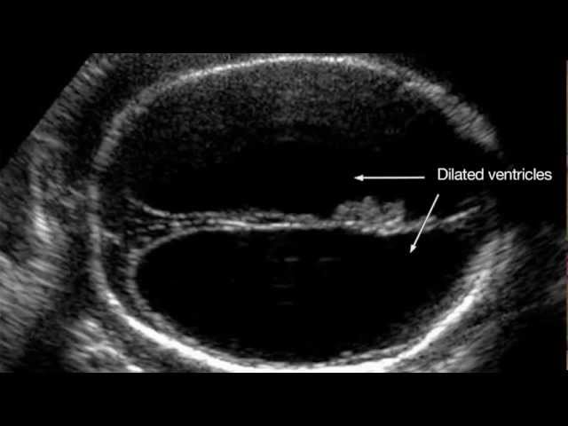 Ultrasound Training Assessment Of Fetal Growth And High Risk Pregnancies Youtube