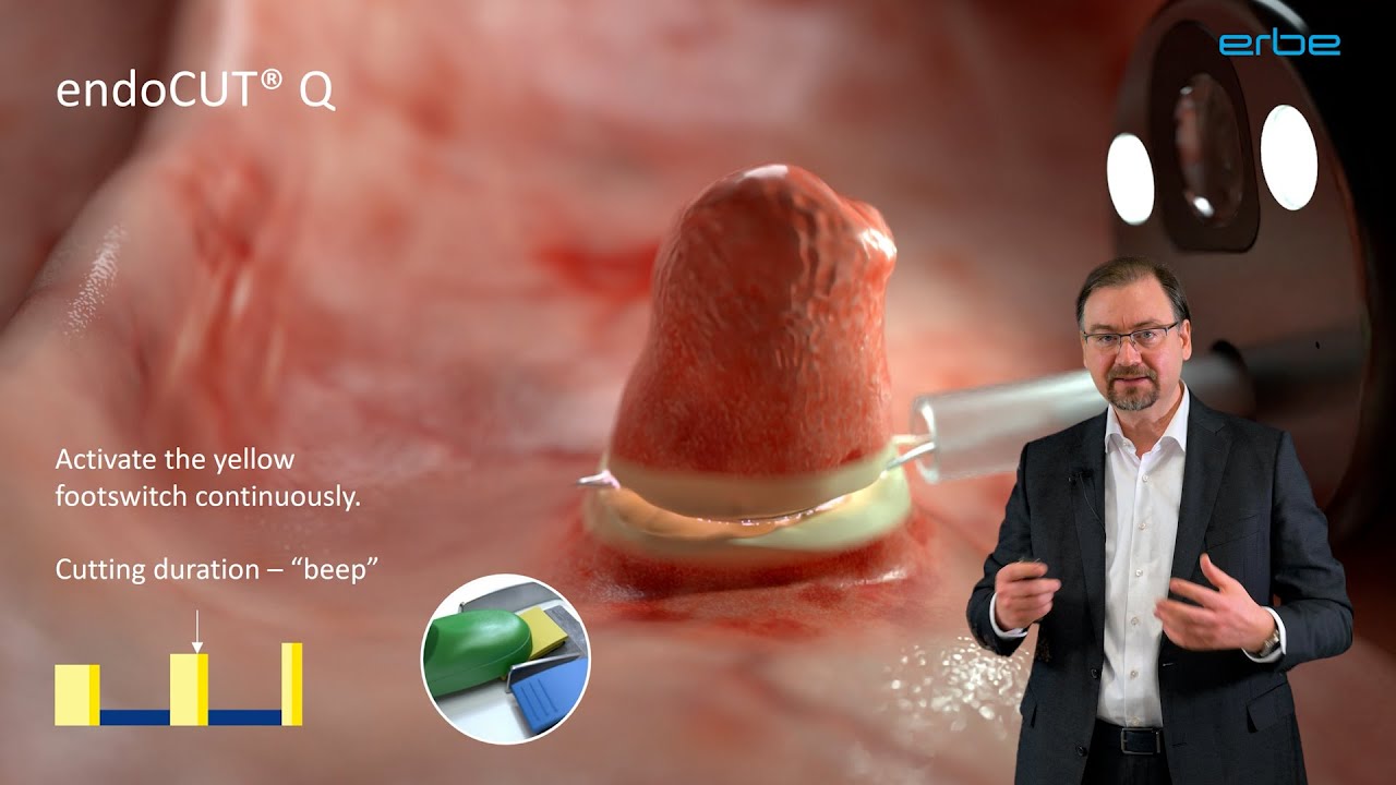 endoCUT® spark recognition technology in endoscopic procedures