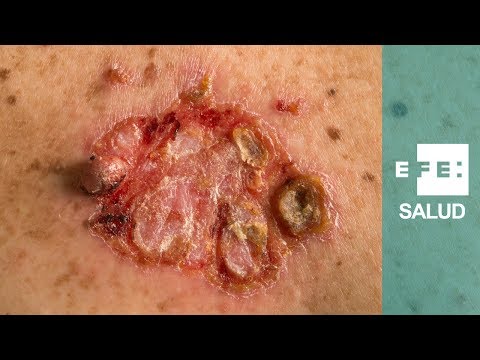 Video: ¿Duele el carcinoma de células escamosas?