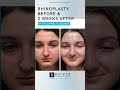 A Dramatic Change in Just 2 Weeks 👃✨ | Rhinoplasty by Dr. Becker