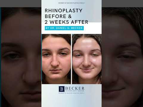 Video thumbnail: A Dramatic Change in Just 2 Weeks 👃✨ | Rhinoplasty by Dr. Becker · Becker Rhinoplasty Center