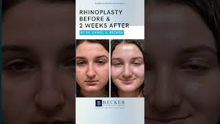 A Dramatic Change in Just 2 Weeks 👃✨ | Rhinoplasty by Dr. Becker