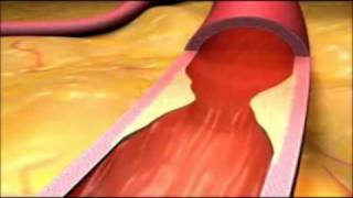 Coronary Artery Disease