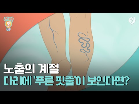 [리빙톡] 노출의 계절, 다리에 '푸른 핏줄'이 보인다면?
