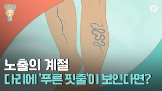 [리빙톡] 노출의 계절, 다리에 '푸른 핏줄'이 보인다면?