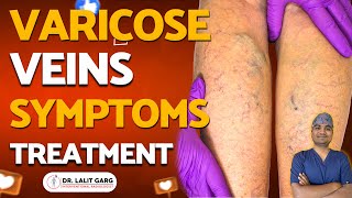 Varicose Veins: Symptoms, Causes, Diagnosis, Prevention and Treatment By Dr. Lalit Garg