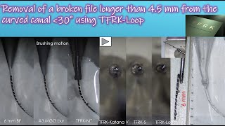 Removal of a broken file longer than 4.5 mm using TFRK-Loop/ループを使った4.5mm以上の破折器具の除去