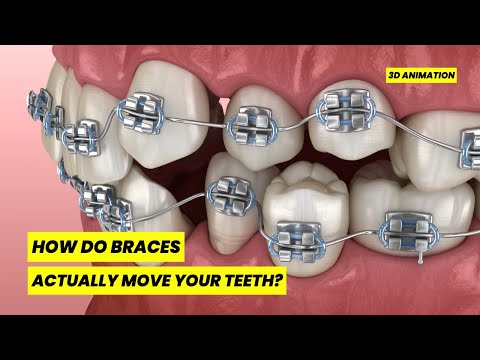 How Do Braces ACTUALLY Move Your Teeth? (SHOCKING 3D Animation)
