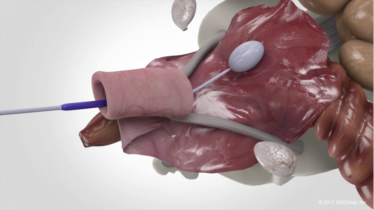 Video animation of how Transvaginal Mesh is implanted and problems develop