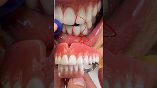 Combination case that we just completed in my laboratory for Dr. Michael Neglia in Illinois