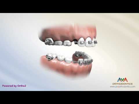 Orthodontic Treatment for Kids - 2x4 Braces