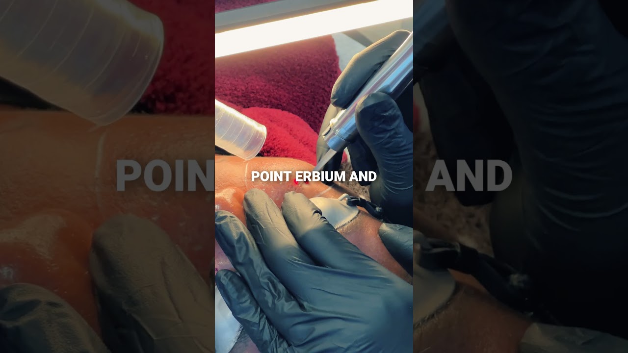 Acne Scar Treatment for Darker Skin 