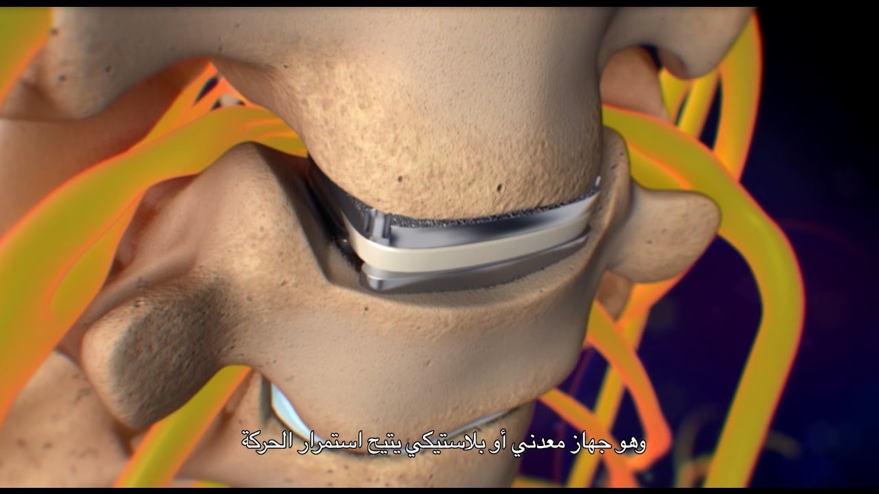 إزالة القرص العنقي