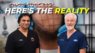 How Long Does a Hair Transplant Last?