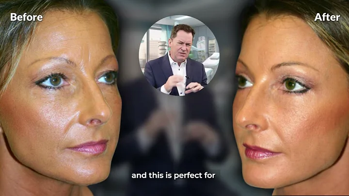 Brow Lift And Blepharoplasty - 45 Year Old - Refresh The Upper Face