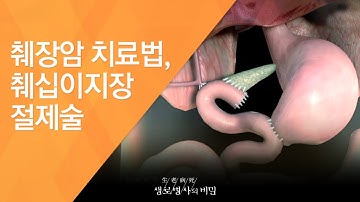 췌장암 치료법, 췌십이지장 절제술 - (2010.7.8_337회 방송)_공포의 췌장암, 절망은 없다