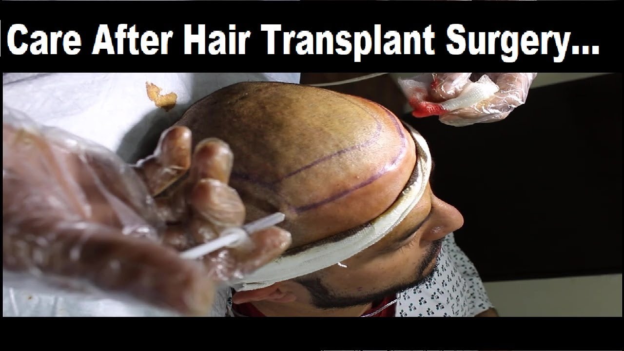 Care After FUE Hair Transplant || Best Hair Transplant In Faisalabad || Zunair Aesthetics